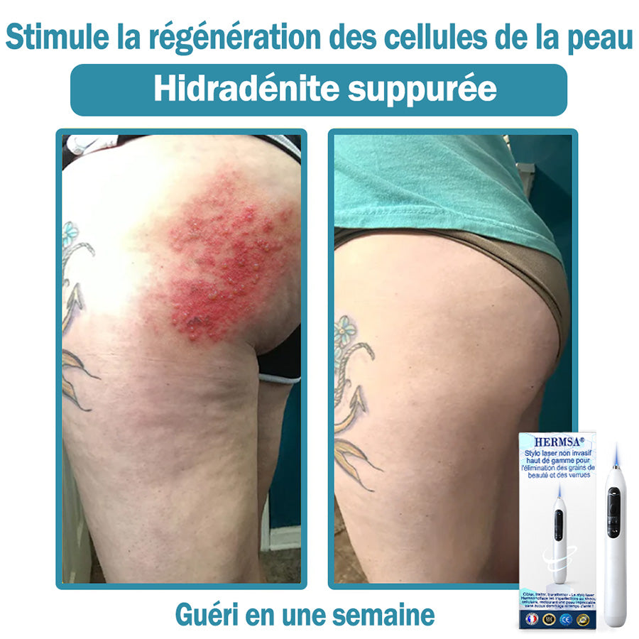 Hermsa® Stylo laser haut de gamme non invasif pour l'élimination des grains de beauté et des verrues