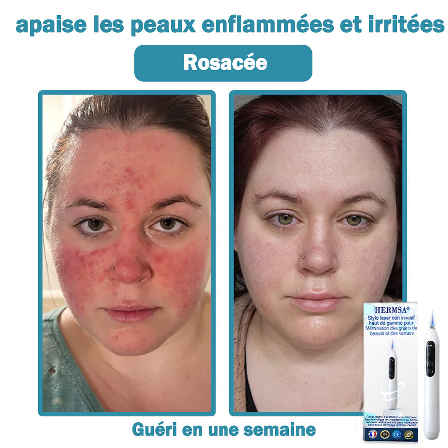 Hermsa® Stylo laser haut de gamme non invasif pour l'élimination des grains de beauté et des verrues