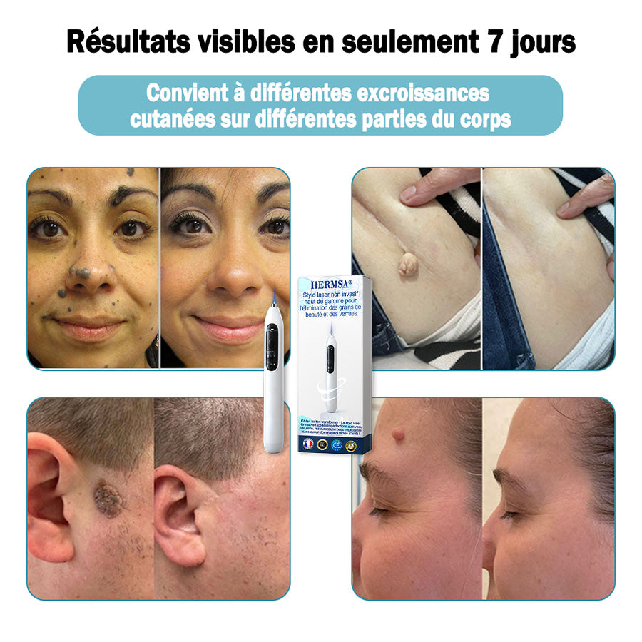 Hermsa® Stylo laser haut de gamme non invasif pour l'élimination des grains de beauté et des verrues