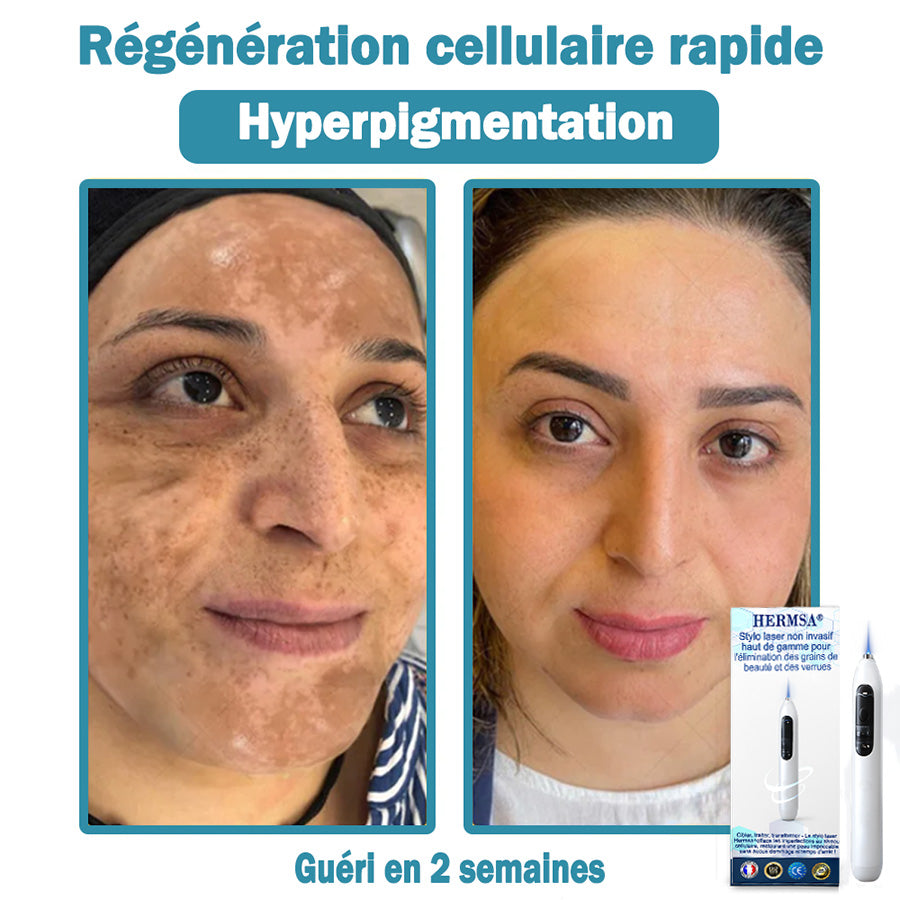 Hermsa® Stylo laser haut de gamme non invasif pour l'élimination des grains de beauté et des verrues