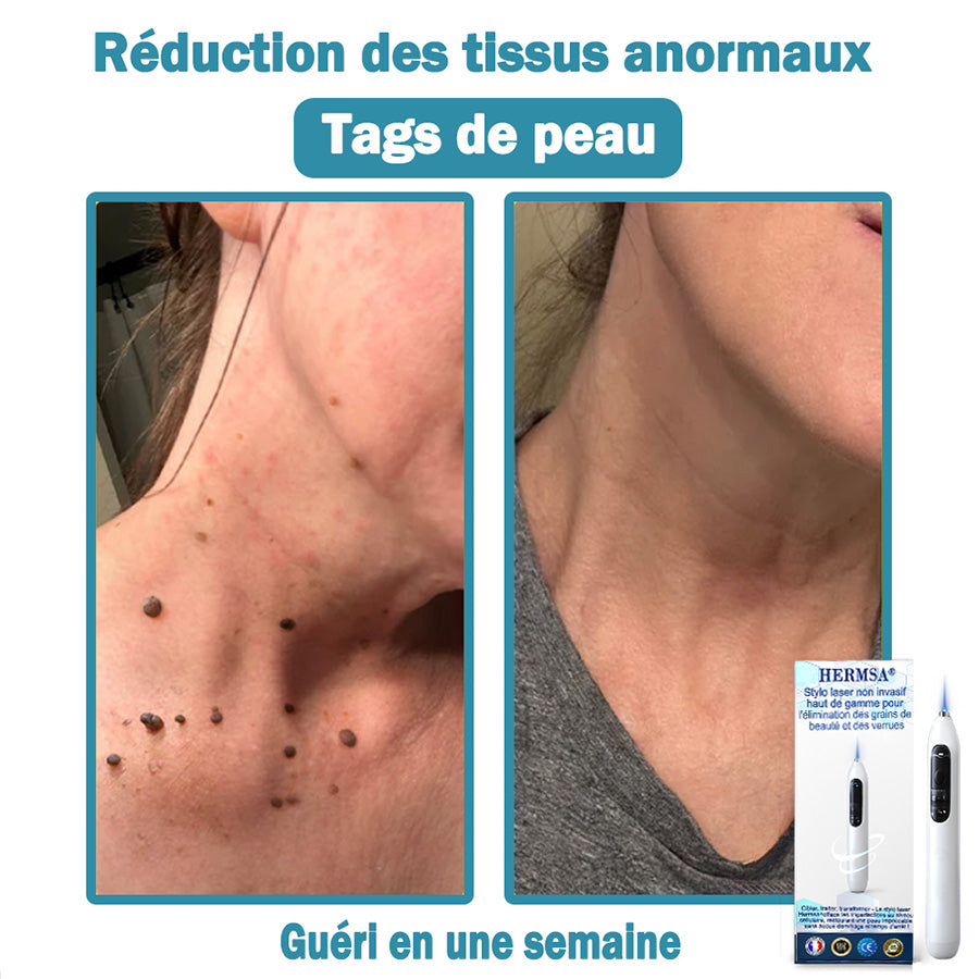 Hermsa® Stylo laser haut de gamme non invasif pour l'élimination des grains de beauté et des verrues